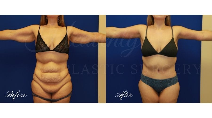 Mommy Makeover - Arm Lift + Tummy Tuck Before and After, Mommy makeover orange county, mommy makeover surgeon, mommy makeover orange county