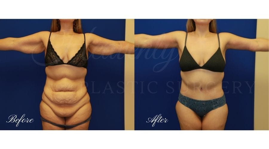 Mommy Makeover - Arm Lift + Tummy Tuck Before and After, Mommy makeover orange county, mommy makeover surgeon, mommy makeover orange county Mommy Makeover - Arm Lift + Tummy Tuck Before and After, Mommy makeover orange county, mommy makeover surgeon, mommy makeover orange county