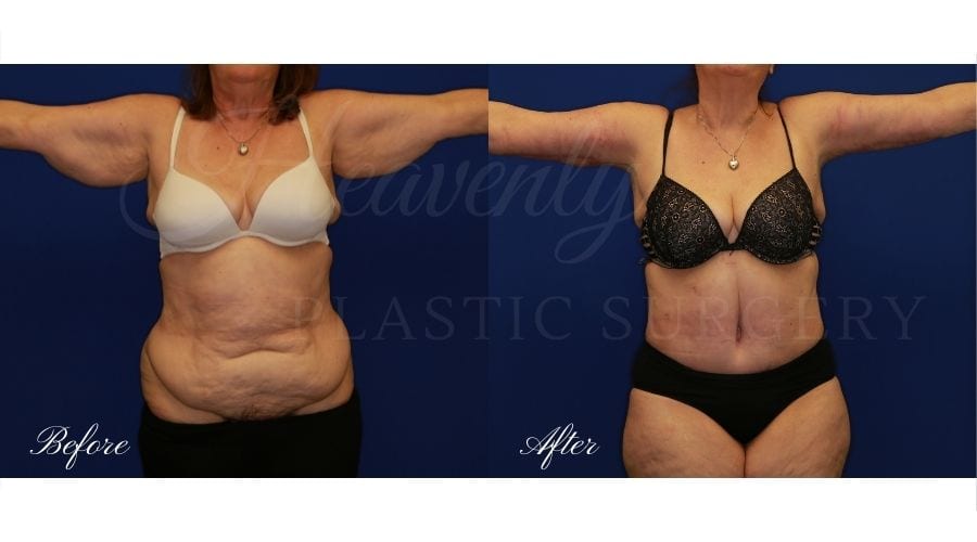 Plastic Surgery, plastic surgeon, tummy tuck, abdominoplasty, weight loss Plastic Surgery, plastic surgeon, tummy tuck, abdominoplasty, weight loss
