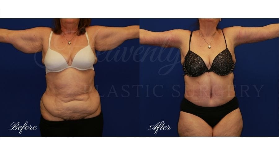 Plastic Surgery, plastic surgeon, tummy tuck, abdominoplasty, weight loss