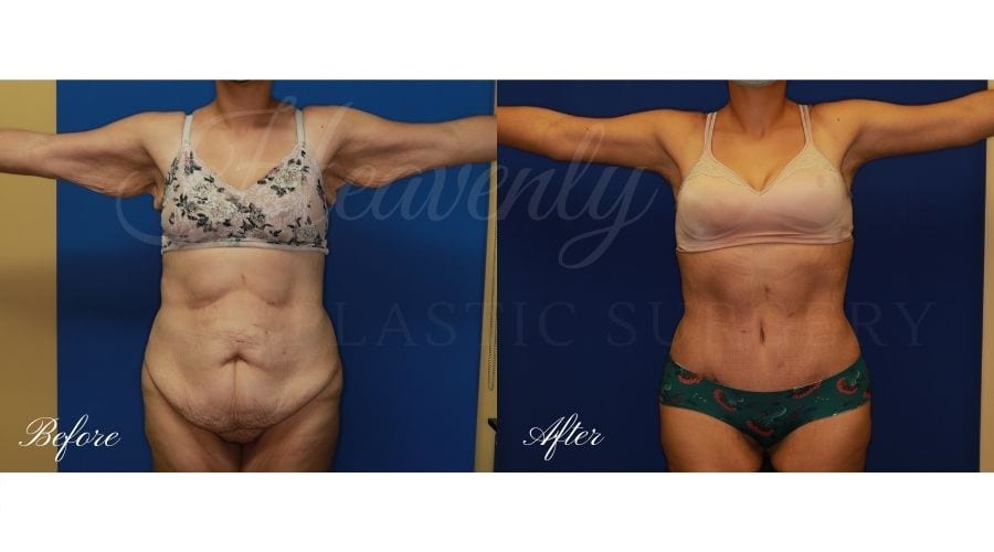 Mommy Makeover - Arm Lift + Tummy Tuck, Plastic Surgery, plastic surgeon, mommy makeover, arm lift, abdominoplasty, brachioplasty, extra skin