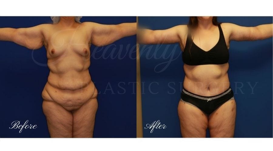 Plastic Surgery, plastic surgeon, tummy tuck, abdominoplasty, weight loss, mommy makeover