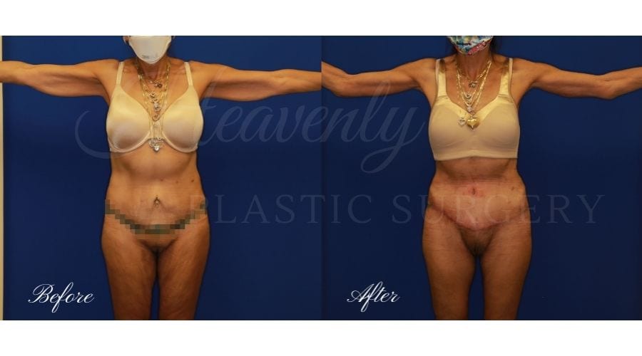 Mommy makeover, weight loss surgery, thigh lift, excess skin, thigh surgery, thigh lift before and after, tummy tuck, abdominoplasty, tummy tuck before and after, abdominoplasty before and after, mommy makeover before and after, weightloss surgery before and after, arm lift, brachioplasty, arm lift before and after, sagging skin, orange county plastic surgeon, thigh lift orange county, tummy tuck orange county, arm lift orange county