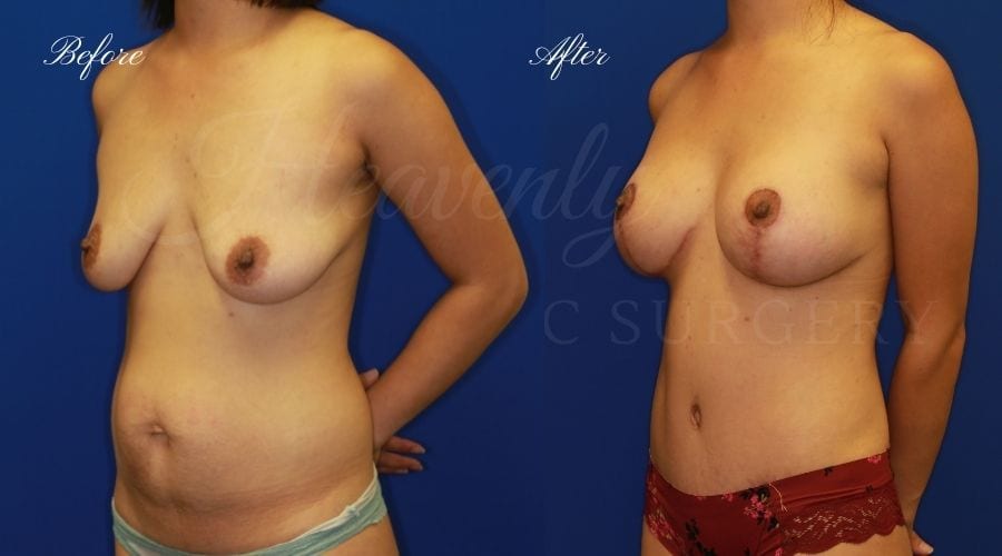 Mommy Makeover before and after, breast augmentation with lift, breast lift with implants, tummy tuck, breast lift with implants before and after, breast augmentation with lift before and after, tummy tuck before and after, abdominoplasty before and after, mommy makeover surgery, mommy makeover surgeon, mommy makeover orange county, heavenly plastic surgery mommy makeover