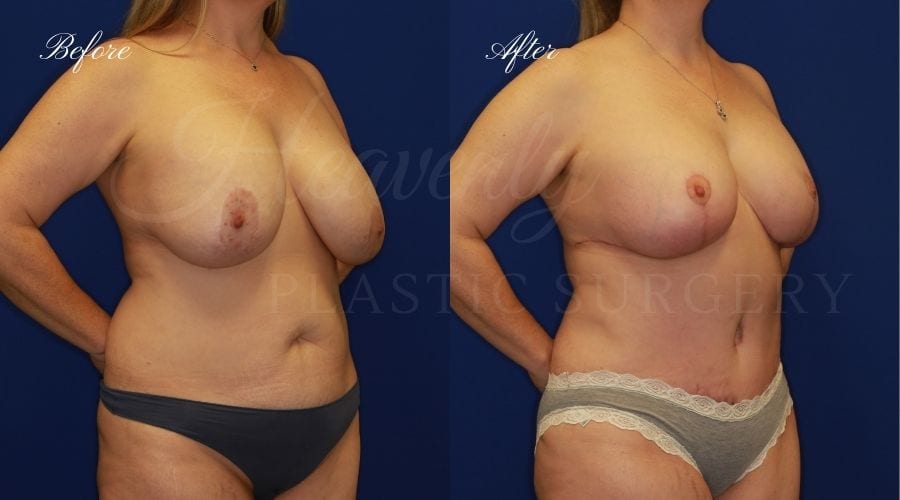 Mommy Makeover - Breast Augmentation, Breast Lift, Tummy Tuck, Liposuction Mommy Makeover - Breast Augmentation, Breast Lift, Tummy Tuck, Liposuction