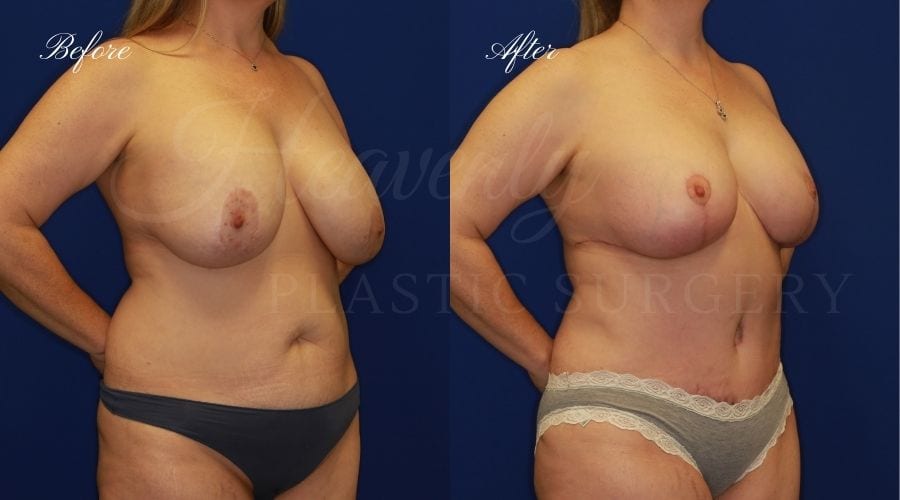 Mommy Makeover - Breast Augmentation, Breast Lift, Tummy Tuck, Liposuction