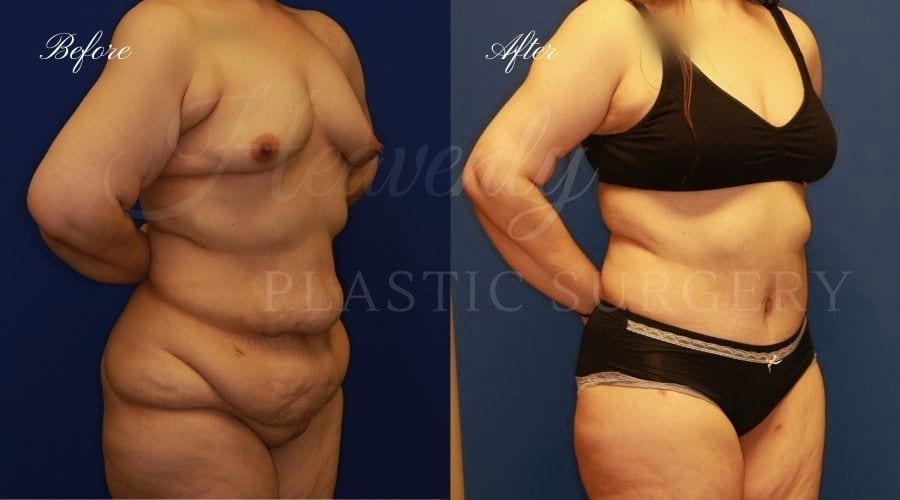 Mommy Makeover Before and After - Tummy Tuck, Plastic Surgery, plastic surgeon, tummy tuck, abdominoplasty, weight loss, mommy makeover Mommy Makeover Before and After - Tummy Tuck, Plastic Surgery, plastic surgeon, tummy tuck, abdominoplasty, weight loss, mommy makeover