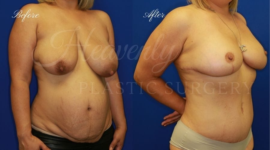 Heavenly Plastic Surgery, Plastic Surgery, Plastic Surgeon, Mommy Makeover, Transformation, Breast Lift, Tummy Tuck, Breast lift without implants, Breast Surgery, Body Surgery, Tummy Tuck, Tummy Tuck with Liposuction, Liposuction