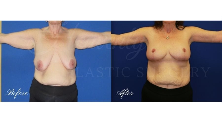 Mommy Makeover - Breast Lift + Tummy Tuck Before and After, Plastic Surgery, plastic surgeon, mastopexy augmentation, arm lift
