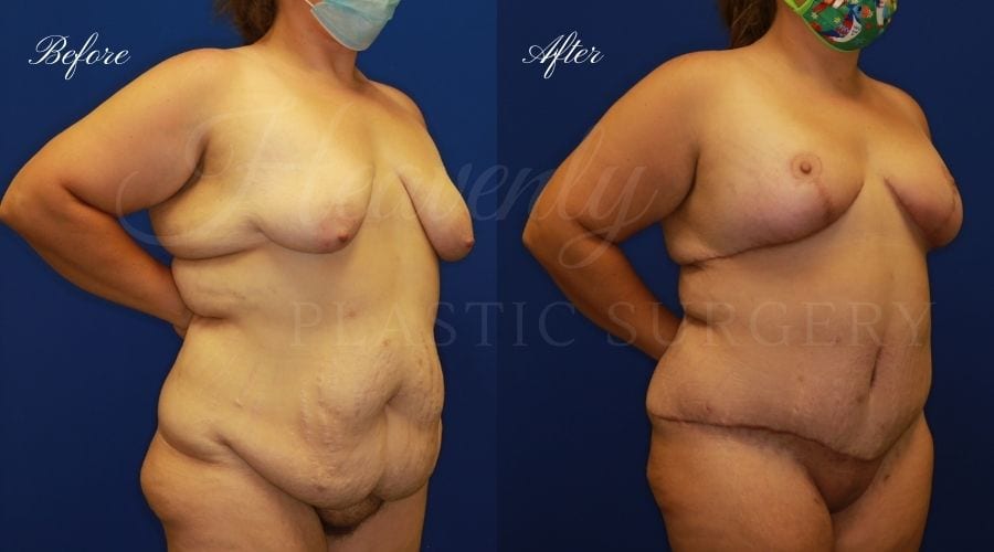 Mommy Makeover, Mommy Makeover Surgery, Mommy Makeover Orange County, Tummy Tuck, Breast Lift, Abdominoplasty, Mastopexy, Tummy Tuck with Liposuction, Breast Lift Surgery, Breast Lift Orange County, Tummy Tuck Orange County, Tummy Tuck Surgery