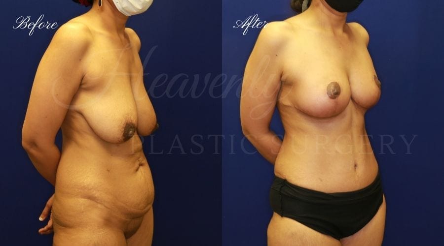 Mommy Makeover - Breast Lift + Tummy Tuck - Right Oblique SHSA Heavenly Plastic Surgery, Plastic Surgery, Plastic Surgeon, Mommy Makeover, Transformation, Breast Lift, Tummy Tuck, Breast lift without implants, Breast Surgery, Body Surgery, Tummy Tuck, Tummy Tuck with Liposuction, Liposuction