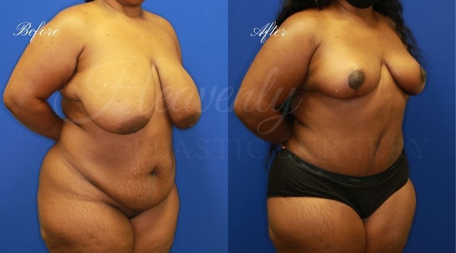 Heavenly Plastic Surgery, Plastic Surgery, Plastic Surgeon, Breast Reduction, Breast Surgery, Breast Lift, Tummy Tuck, Tummy Tuck with liposuction, Tummy Tuck with Lipo, Liposuction, Lipo, macromastia, large breast surgery, enlarged breast surgery Heavenly Plastic Surgery, Plastic Surgery, Plastic Surgeon, Breast Reduction, Breast Surgery, Breast Lift, Tummy Tuck, Tummy Tuck with liposuction, Tummy Tuck with Lipo, Liposuction, Lipo, macromastia, large breast surgery, enlarged breast surgery