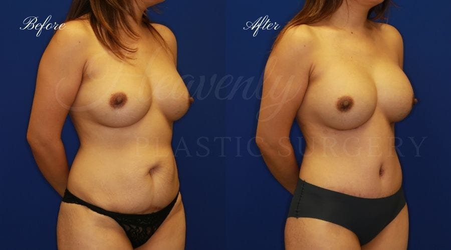 Mommy Makeover - Implant Exchange + Tummy Tuck Before and After, Mommy Makeover Orange County, Mommy Makeover Surgeon, Mommy Makeover Surgery Mommy Makeover - Implant Exchange + Tummy Tuck Before and After, Mommy Makeover Orange County, Mommy Makeover Surgeon, Mommy Makeover Surgery