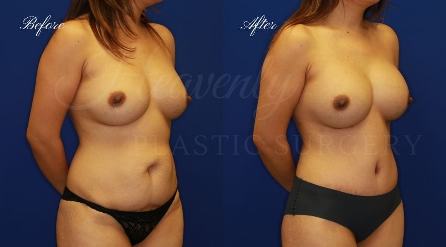 Mommy Makeover - Implant Exchange + Tummy Tuck Before and After, Mommy Makeover Orange County, Mommy Makeover Surgeon, Mommy Makeover Surgery