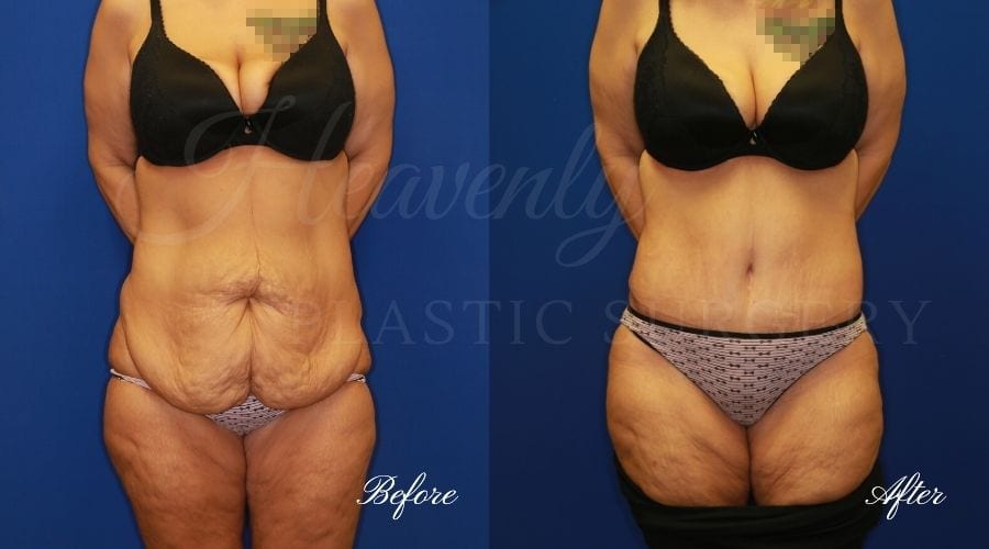 Mommy Makeover - Tummy Tuck Before and After, Plastic Surgery, Plastic Surgeon, Tummy Tuck, Arm Lift, Breast Lift, Liposuction