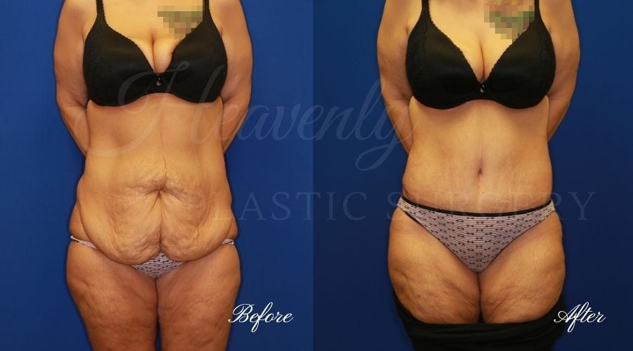 Mommy Makeover - Tummy Tuck Before and After, Plastic Surgery, Plastic Surgeon, Tummy Tuck, Arm Lift, Breast Lift, Liposuction Mommy Makeover - Tummy Tuck Before and After, Plastic Surgery, Plastic Surgeon, Tummy Tuck, Arm Lift, Breast Lift, Liposuction