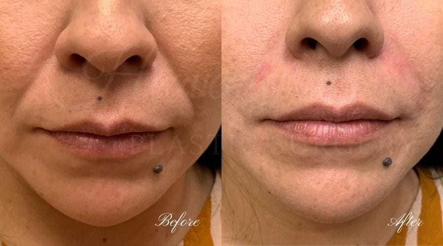 Nasolabial Fold filler, nasolabial fold filler orange county, filler orange county, filler, versa, versa filler, smile line filler, smile lines, filler for smile lines, smile line filler orange county Nasolabial Fold filler, nasolabial fold filler orange county, filler orange county, filler, versa, versa filler, smile line filler, smile lines, filler for smile lines, smile line filler orange county