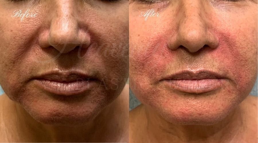plastic surgery, plastic surgeon, nasolabial folds, laugh lines, laugh line fillers, nasolabial fold fillers, nasolabial fillers, hyaluronic acid, fillers, injectables, liquid facelift plastic surgery, plastic surgeon, nasolabial folds, laugh lines, laugh line fillers, nasolabial fold fillers, nasolabial fillers, hyaluronic acid, fillers, injectables, liquid facelift