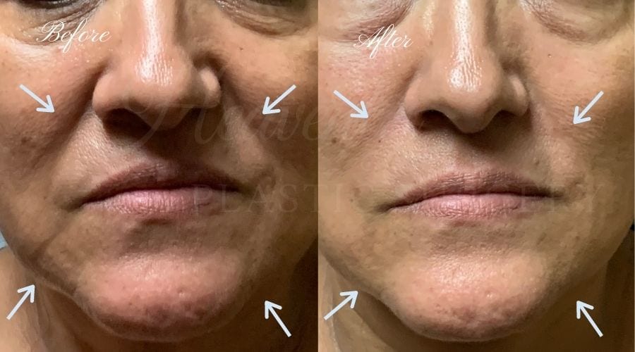 Nasolabial Fold filler, nasolabial fold filler orange county, filler orange county, filler, versa, versa filler, smile line filler, smile lines, filler for smile lines, smile line filler orange county