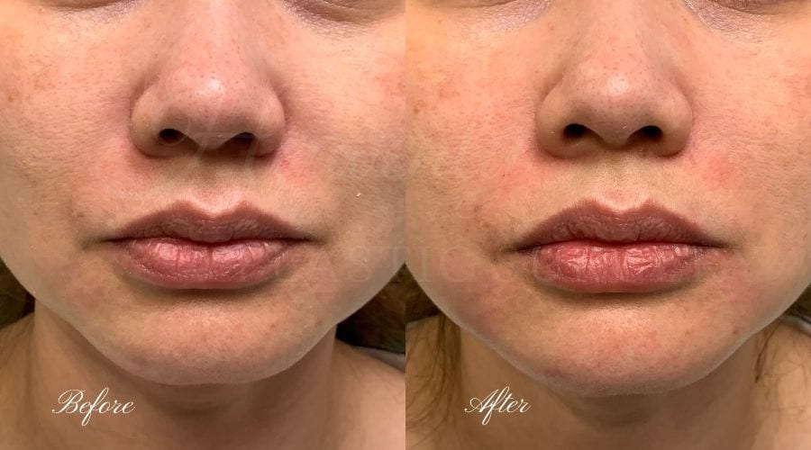 Lip filler, lip injection, juvederm, volbella, bigger lips, more lip volume, Versa, Revanesse Versa, nasolabial folds, smile lines, laugh lines Lip filler, lip injection, juvederm, volbella, bigger lips, more lip volume, Versa, Revanesse Versa, nasolabial folds, smile lines, laugh lines