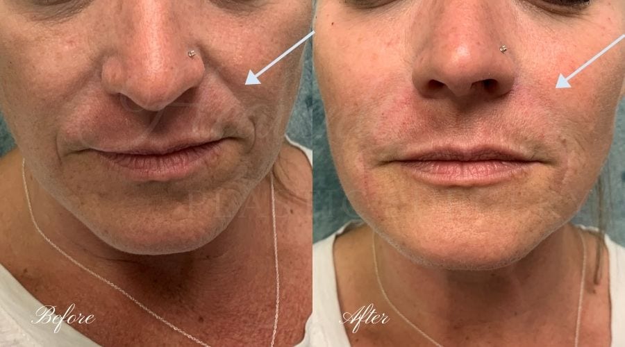 filler, juvederm, vollure, nasolabial fold filler, cheek lines filler, juvederm, vollure, nasolabial fold filler, cheek lines