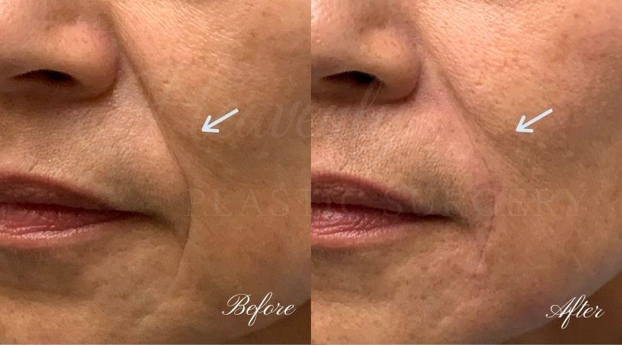 filler, juvederm, vollure, nasolabial fold filler, cheek lines filler, juvederm, vollure, nasolabial fold filler, cheek lines