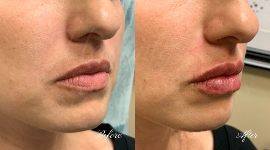 Lip filler, lip injection, juvederm, volbella, bigger lips, more lip volume, Versa, Revanesse Versa