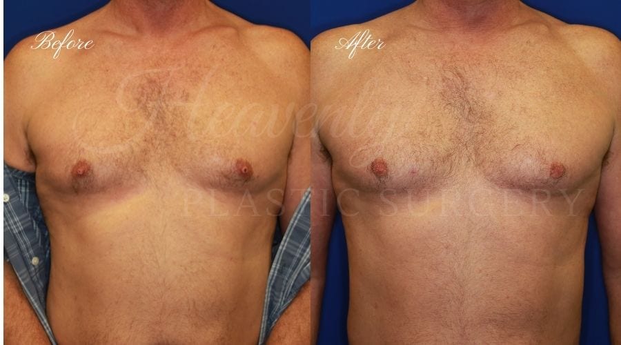 Nipple Amputation, Nipple Removal, Plastic Surgery, Plastic Surgeon, Nipple Chaffing, nipple surgery Nipple Amputation, Nipple Removal, Plastic Surgery, Plastic Surgeon, Nipple Chaffing, nipple surgery
