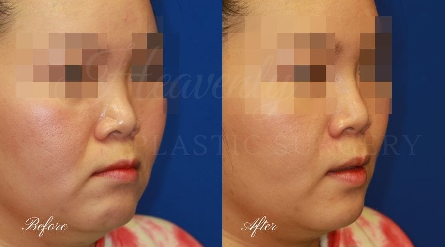 Nonsurgical rhinoplasty, nonsurgical nose job, filler nose, juvederm, vollure, volbella Nonsurgical rhinoplasty, nonsurgical nose job, filler nose, juvederm, vollure, volbella