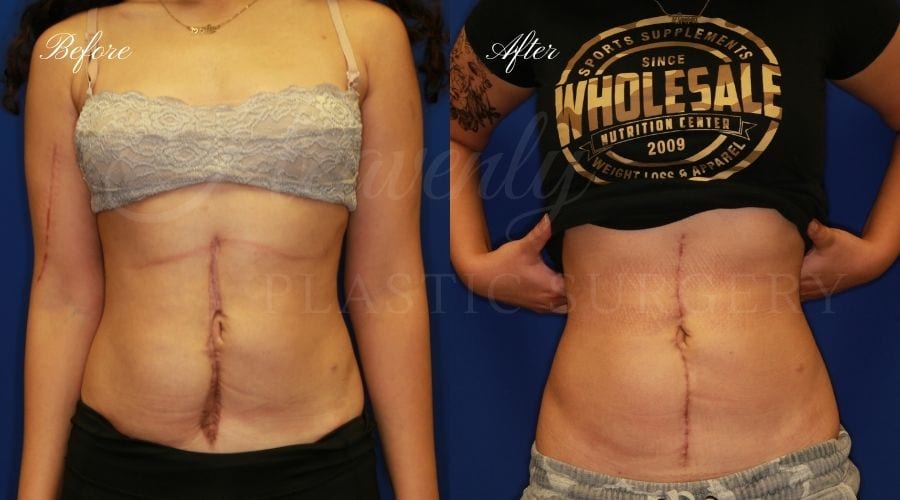 Plastic Surgery, plastic surgeon, scar revision, abdominal scar Plastic Surgery, plastic surgeon, scar revision, abdominal scar