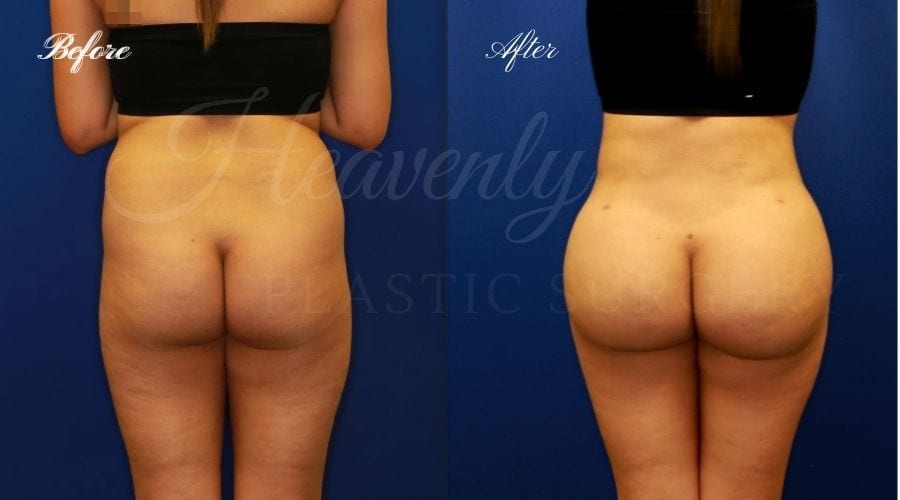 Brazilian Butt Lift, BBL, BBL Before and After, Brazilian Butt Lift Before and After, Butt Lift Before and After, BBL Orange County, Brazilian Butt Lift Orange County, Plastic Surgery Before and After, Plastic Surgery Orange County, Orange County Plastic Surgeon, peach butt, heart butt, peach butt surgery, butt surgery, butt surgery before and after