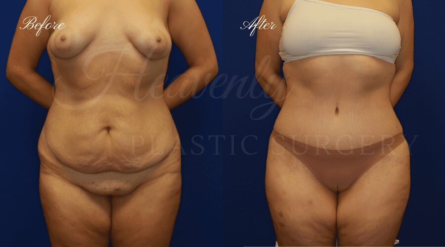 Plastic Surgery, plastic surgeon, tummy tuck, abdominoplasty, weight loss