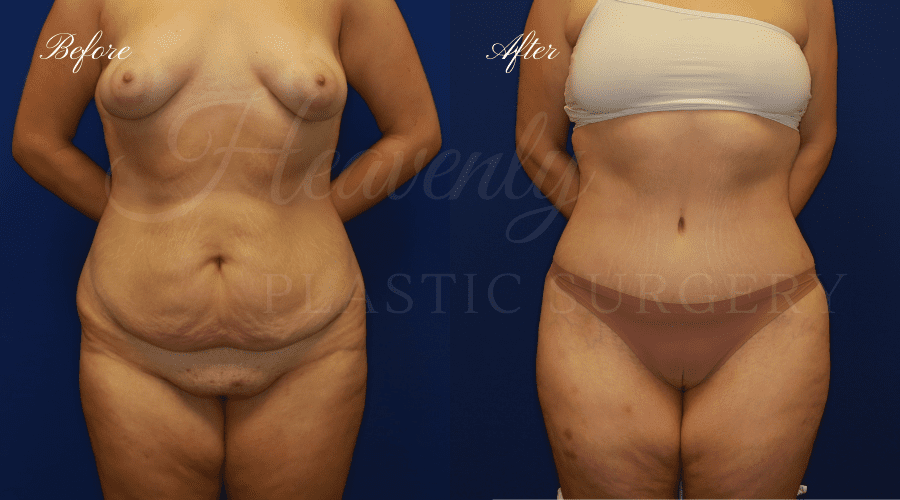 Tummy Tuck Gallery - Heavenly Plastic Surgery