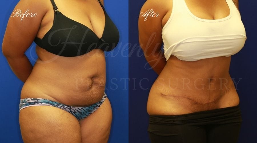 Plastic Surgery, plastic surgeon, tummy tuck, abdominoplasty, weight loss