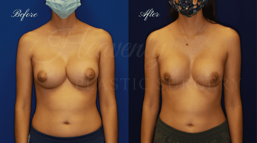 Uniboob Correction Implant Exchange Before and After, Plastic Surgery, Plastic Surgeon, Breast Implant Exchange, Implant Exchange, Breast Implant Revision