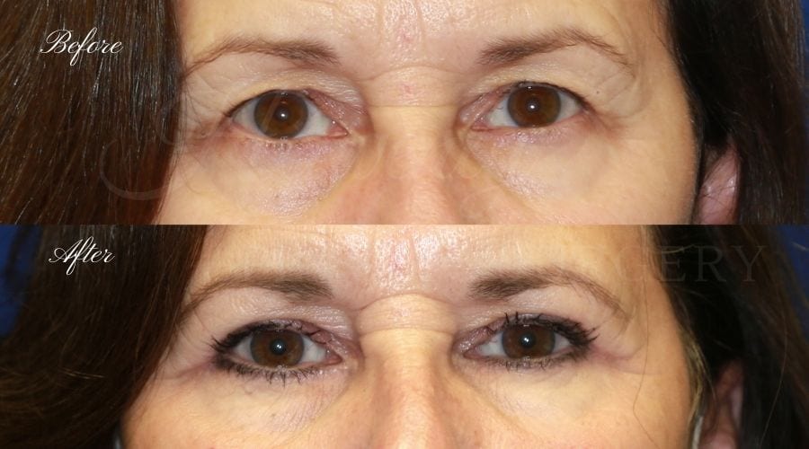 Plastic surgeon, plastic surgery, upper blepharoplasty, eyelid surgery