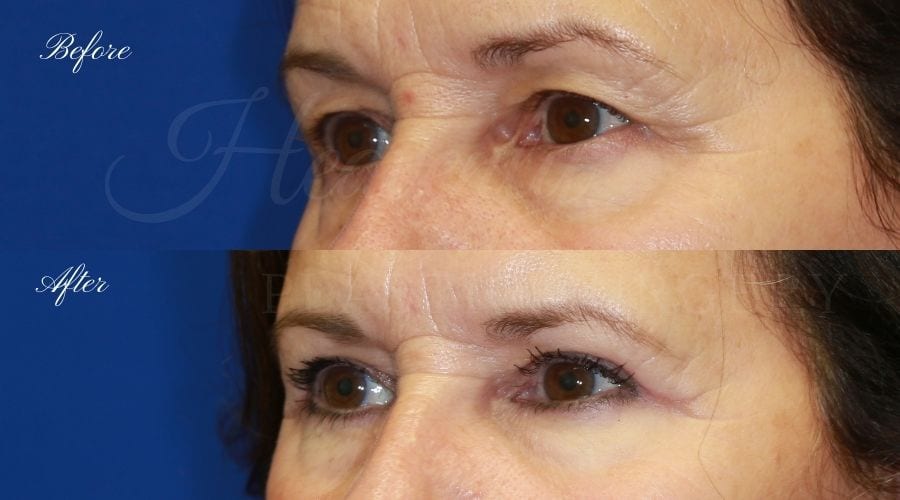 Plastic surgeon, plastic surgery, upper blepharoplasty, eyelid surgery