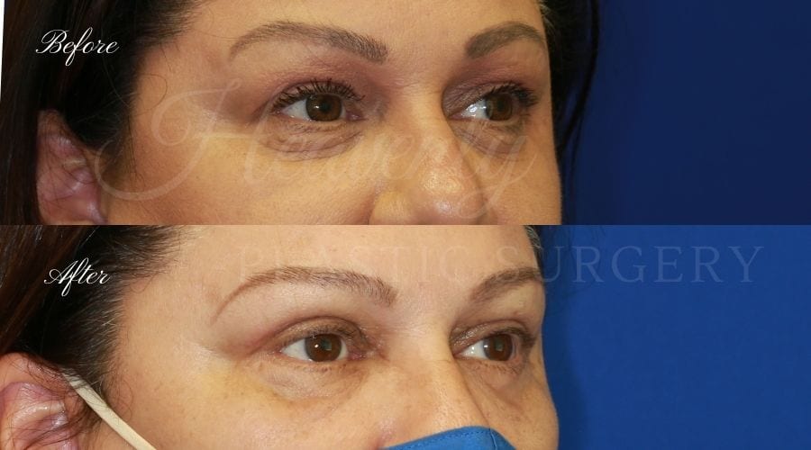 Upper Blepharoplasty Before and After - Right Oblique SABR Plastic surgeon, plastic surgery, upper blepharoplasty, eyelid surgery, lower blepharoplasty, droopy eyelids