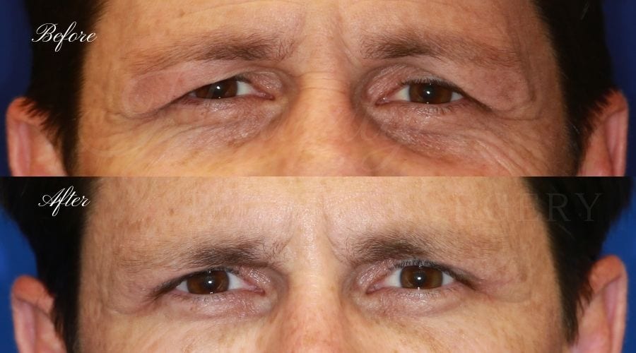 Plastic surgeon, plastic surgery, upper blepharoplasty, eyelid surgery, upper eyelid, upper eyelid surgery, upper blepharoplasty, upper bleph