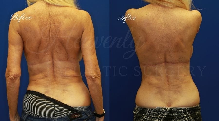 back lift surgery, back lift, back lift surgeon, weight loss surgeon, back surgery, back lift before and after, back lift orange county back lift surgery, back lift, back lift surgeon, weight loss surgeon, back surgery, back lift before and after, back lift orange county
