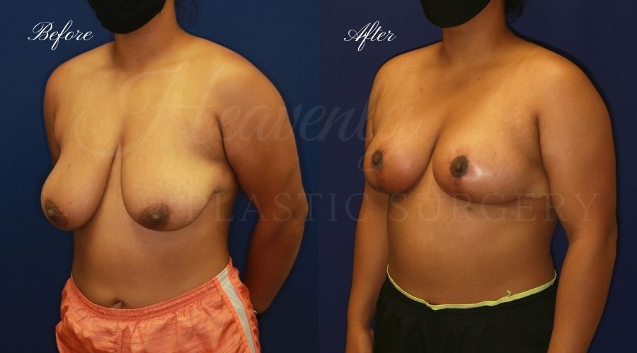 Breast lift surgery, breast lift, breast lift surgeon, mastopexy, mastopexy surgery, breast lift without implants, breast lift orange county, plastic surgery before and after, breast lift before and after, breast lift results, breast reduction, breast reduction results, plastic surgeon, plastic surgery, orange county plastic surgery, orange county plastic surgeon