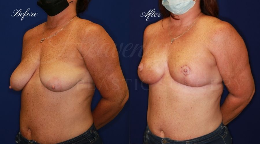 Breast lift surgery, breast lift, breast lift surgeon, mastopexy, mastopexy surgery, breast lift without implants, breast lift orange county, plastic surgery before and after, breast lift before and after, breast lift results, breast reduction, breast reduction results, plastic surgeon, plastic surgery, orange county plastic surgery, orange county plastic surgeon