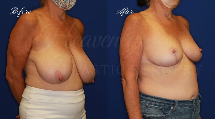 Breast lift surgery, breast lift, breast lift surgeon, mastopexy, mastopexy surgery, breast lift without implants, breast lift orange county, plastic surgery before and after, breast lift before and after, breast lift results, breast reduction, breast reduction results, plastic surgeon, plastic surgery, orange county plastic surgery, orange county plastic surgeon