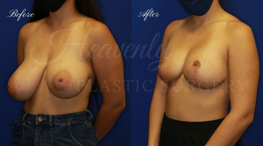 Breast lift surgery, breast lift, breast lift surgeon, mastopexy, mastopexy surgery, breast lift without implants, breast lift orange county, plastic surgery before and after, breast lift before and after, breast lift results, breast reduction, breast reduction results, plastic surgeon, plastic surgery, orange county plastic surgery, orange county plastic surgeon