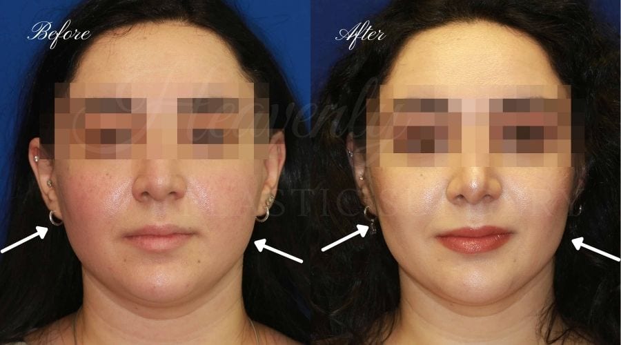 Buccal Fat Pad Removal, Buccal Fat Pad Removal Surgery, Cheekbone surgery, Cheek Plastic Surgery, Cheekbone Plastic Surgery, Cheek Surgery, Cheek Plastic Surgery, Contour Buccal Fat Pad Removal, Buccal Fat Pad Removal Surgery, Cheekbone surgery, Cheek Plastic Surgery, Cheekbone Plastic Surgery, Cheek Surgery, Cheek Plastic Surgery, Contour