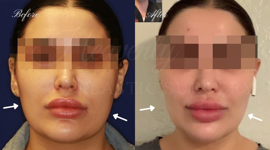 Buccal Fat Pad Removal, Buccal Fat Pad Removal Surgery, Cheekbone surgery, Cheek Plastic Surgery, Cheekbone Plastic Surgery, Cheek Surgery, Cheek Plastic Surgery, Contour Buccal Fat Pad Removal, Buccal Fat Pad Removal Surgery, Cheekbone surgery, Cheek Plastic Surgery, Cheekbone Plastic Surgery, Cheek Surgery, Cheek Plastic Surgery, Contour