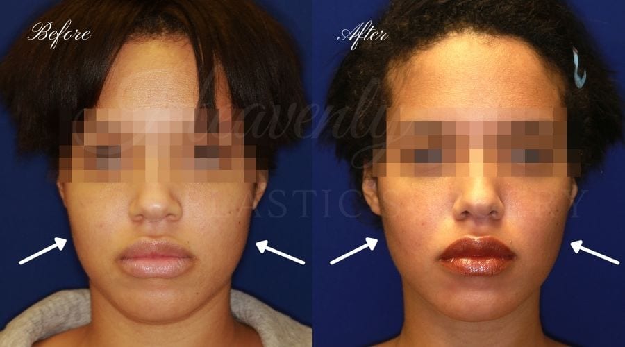 Buccal fat pad removal – Before and After Pictures *