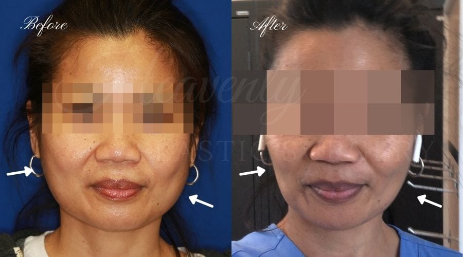 Buccal Fat Pad Removal, Buccal Fat Pad Removal Surgery, Cheekbone surgery, Cheek Plastic Surgery, Cheekbone Plastic Surgery, Cheek Surgery, Cheek Plastic Surgery, Contour Buccal Fat Pad Removal, Buccal Fat Pad Removal Surgery, Cheekbone surgery, Cheek Plastic Surgery, Cheekbone Plastic Surgery, Cheek Surgery, Cheek Plastic Surgery, Contour