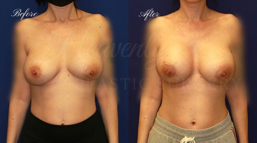 Plastic surgery, plastic surgeon, breast surgery, breast implant revision, deflated breast implant, breast augmentation correction