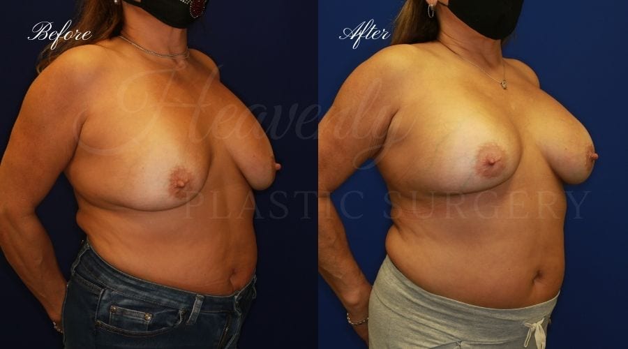 Plastic surgery, plastic surgeon, breast surgery, breast implant revision, deflated breast implant, breast augmentation correction